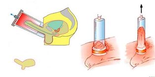 the principle of the pump for penis enlargement